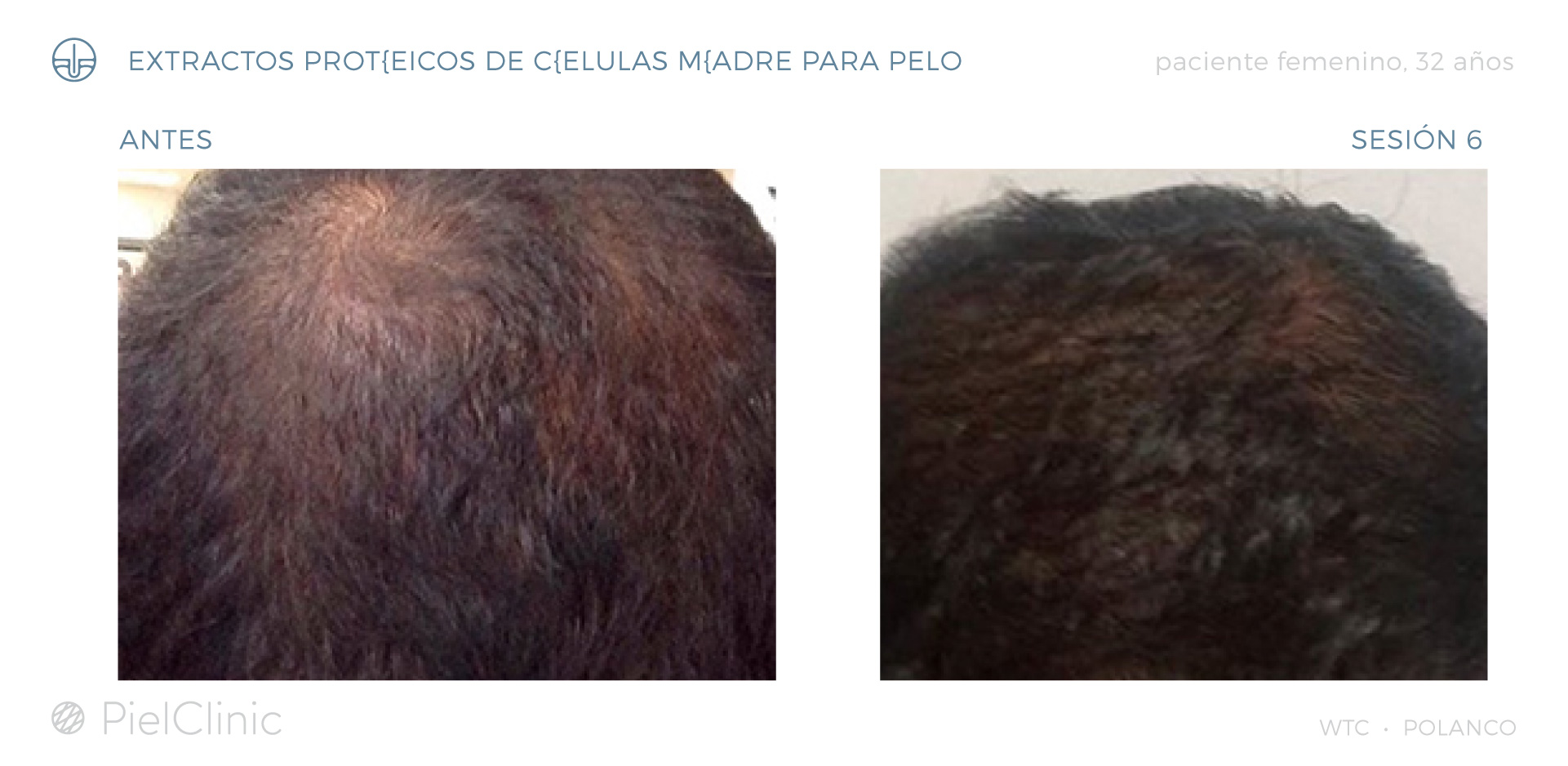 Alopecia en hombres